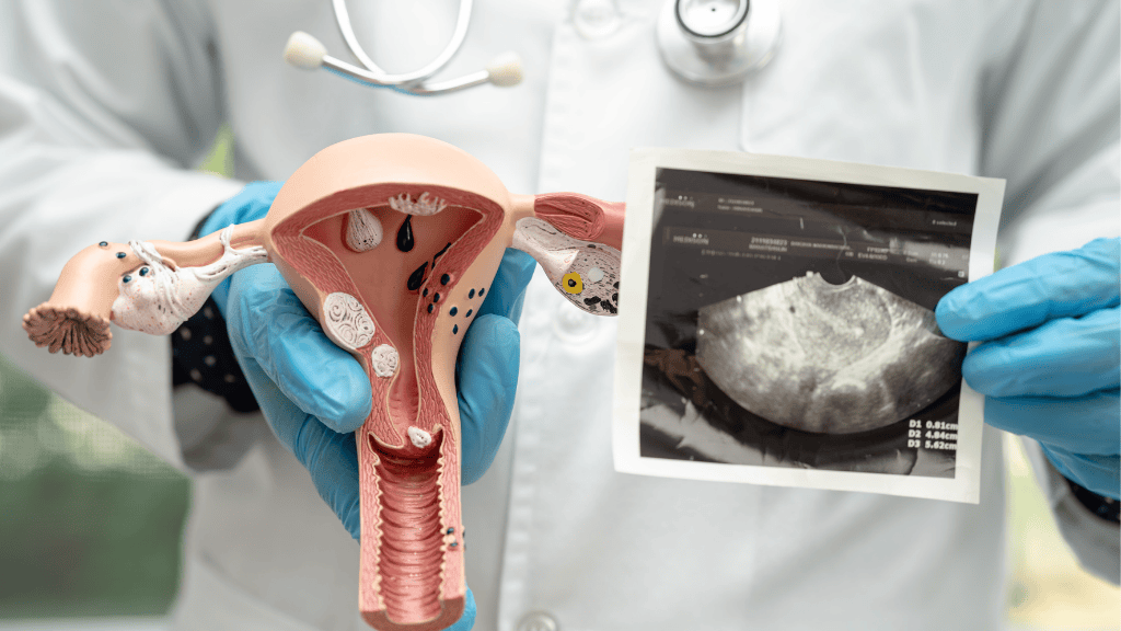 Síndrome de ovario poliquístico